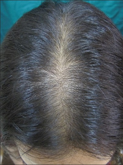 Female Pattern Baldness or Alopecia Areata? - The School of Applied  Functional Medicine